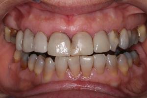 Before Tooth Whitening Treatment
