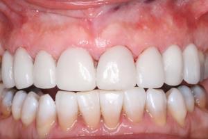 After Tooth Whitening Treatment